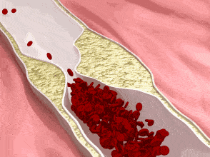 治疗红细胞聚集,消除血栓隐患(图1)
